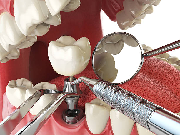 Best Emergency Dentist for Lost Fillings or Crowns in Kenmar, PA
